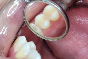 Revision de Dientes Revision de Dientes